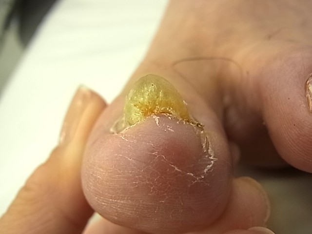 横須賀市　巻き爪　ビフォー