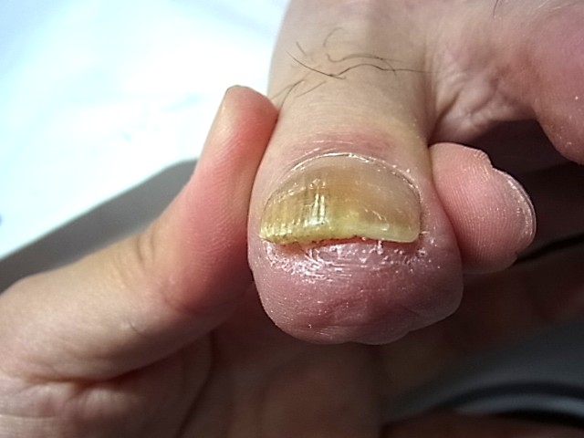 横須賀市　巻き爪　アフター