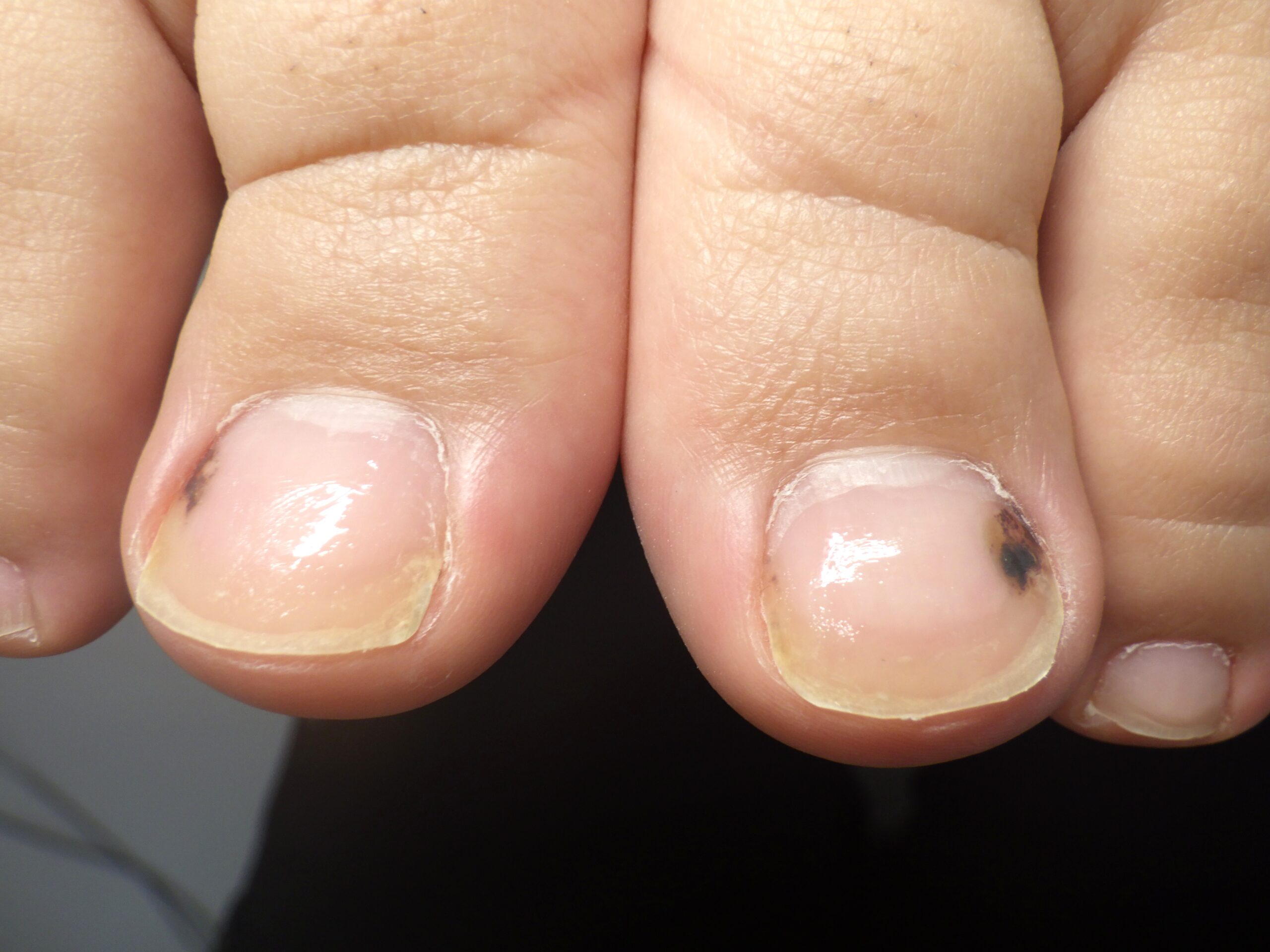 横須賀市　巻き爪　アフター