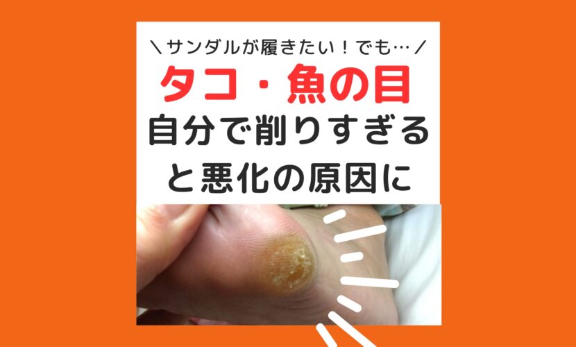 海老名市　巻き爪　タコ　魚の目