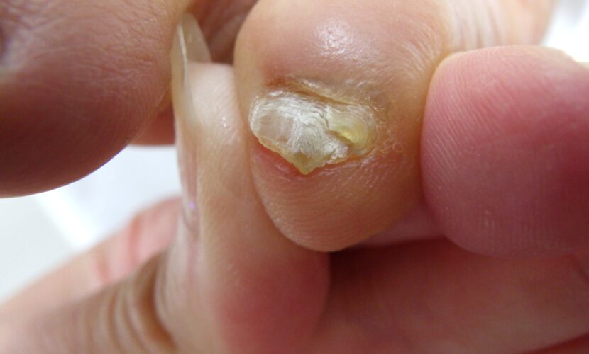 海老名市　巻き爪　副爪