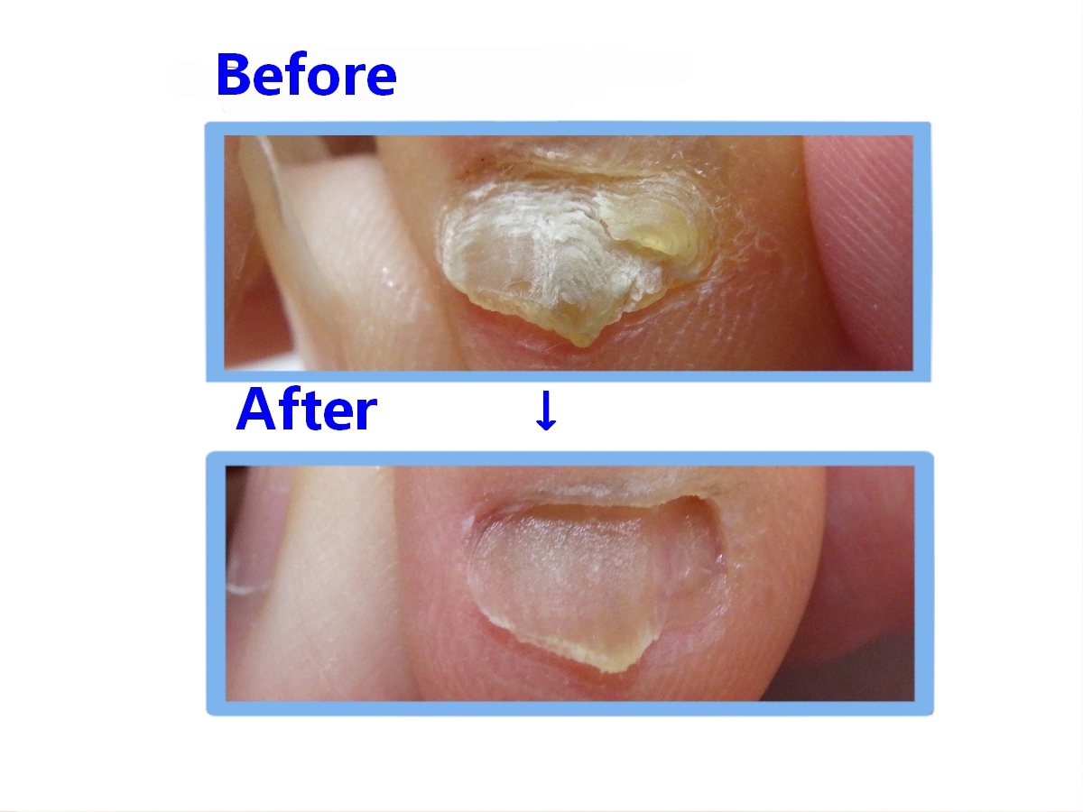 海老名市　巻き爪　副爪