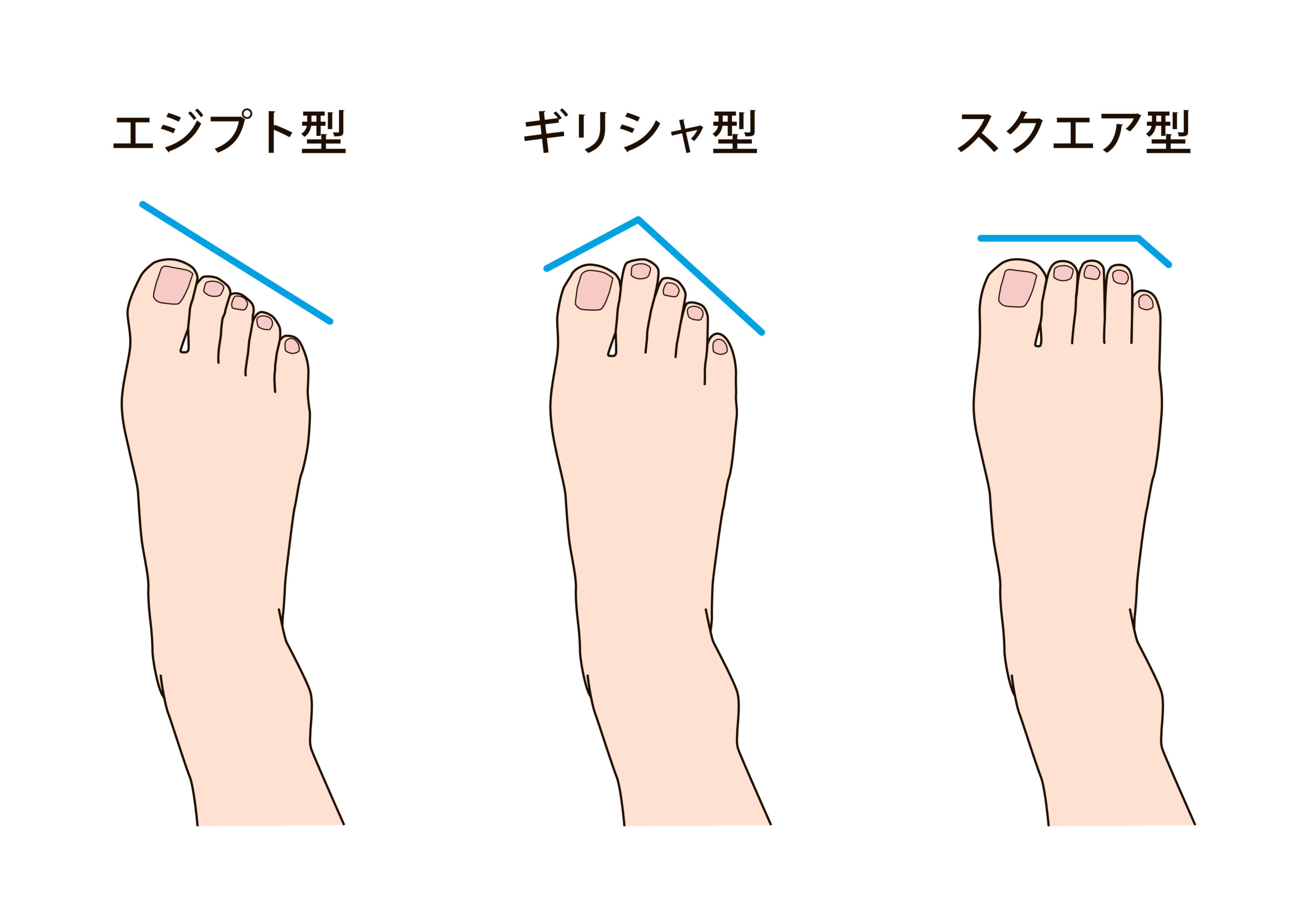 海老名市　巻き爪　足