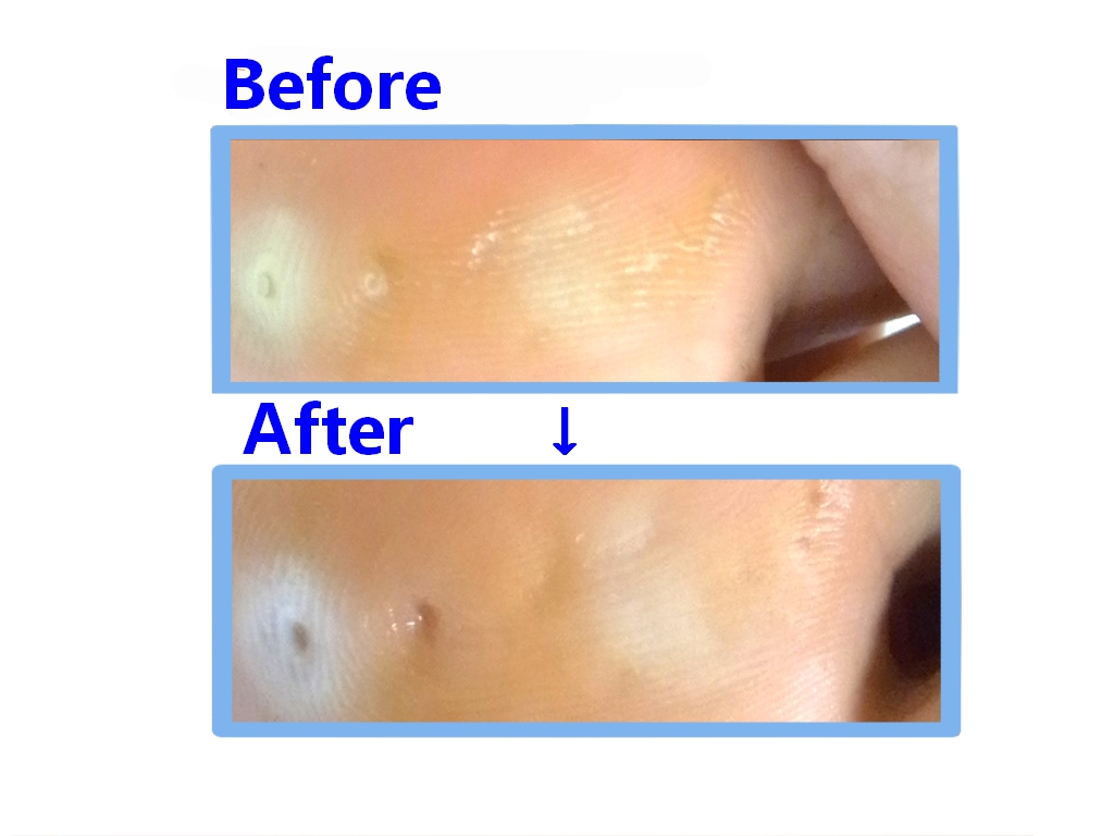 海老名市　巻き爪　魚の目