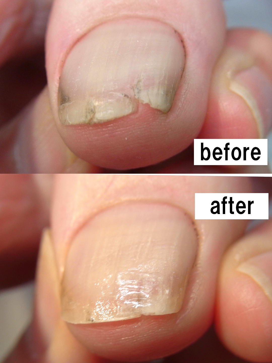 海老名市 巻き爪 割れ爪