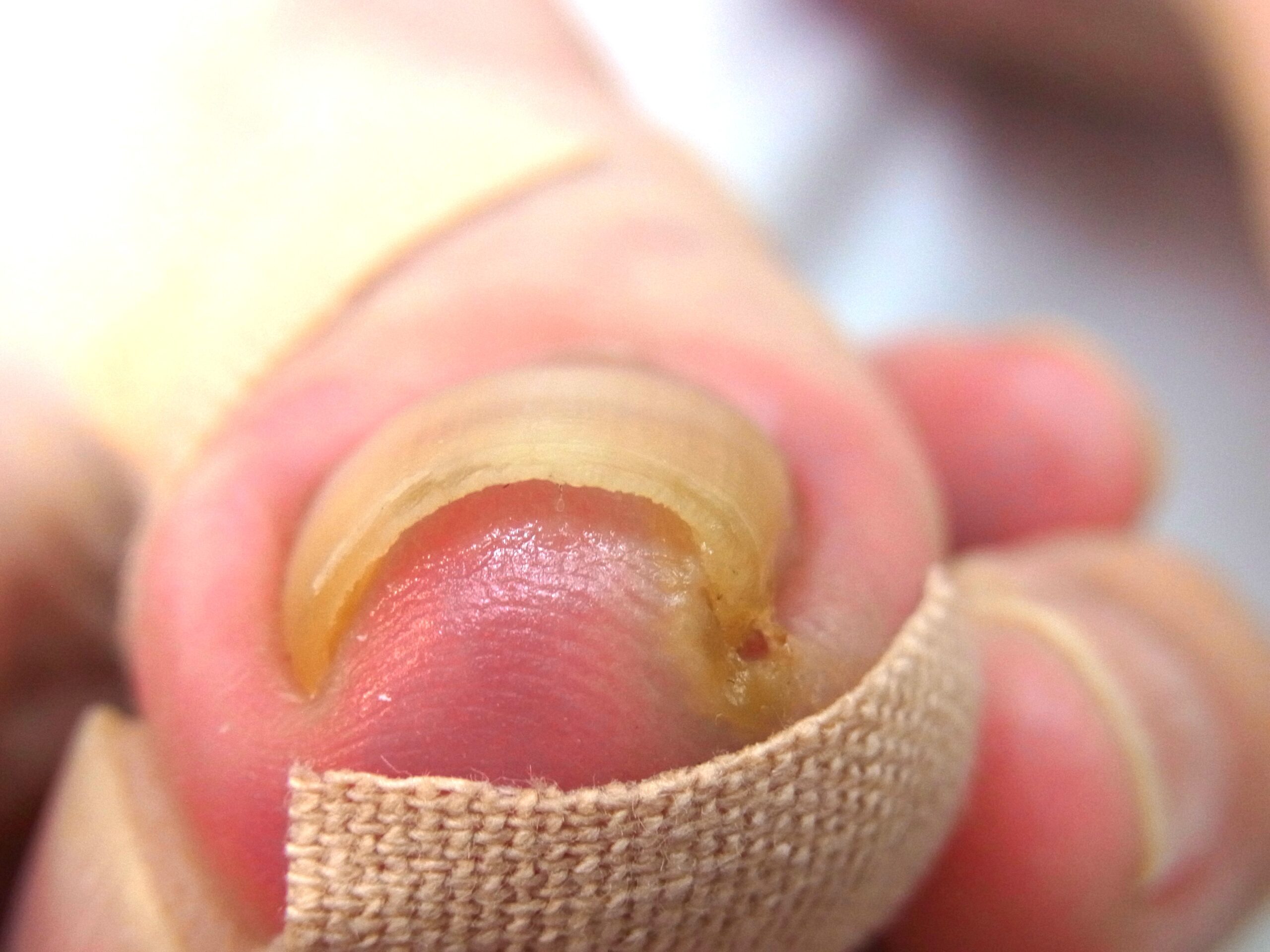 海老名市　巻き爪　ビフォー