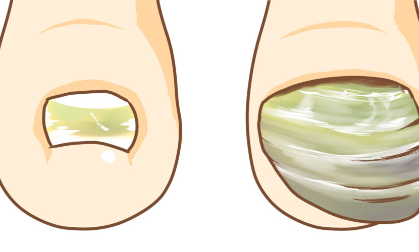 海老名市　巻き爪　変形爪