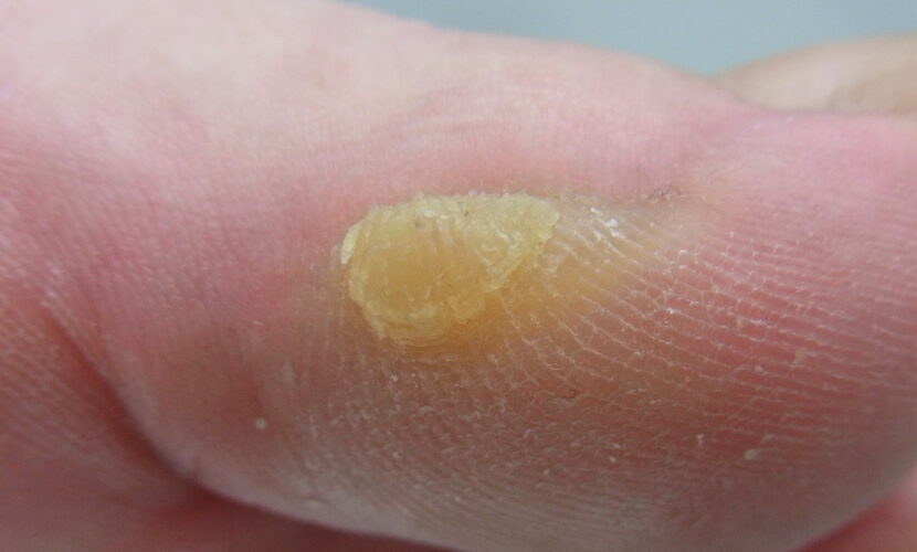 海老名市　巻き爪　ビフォー