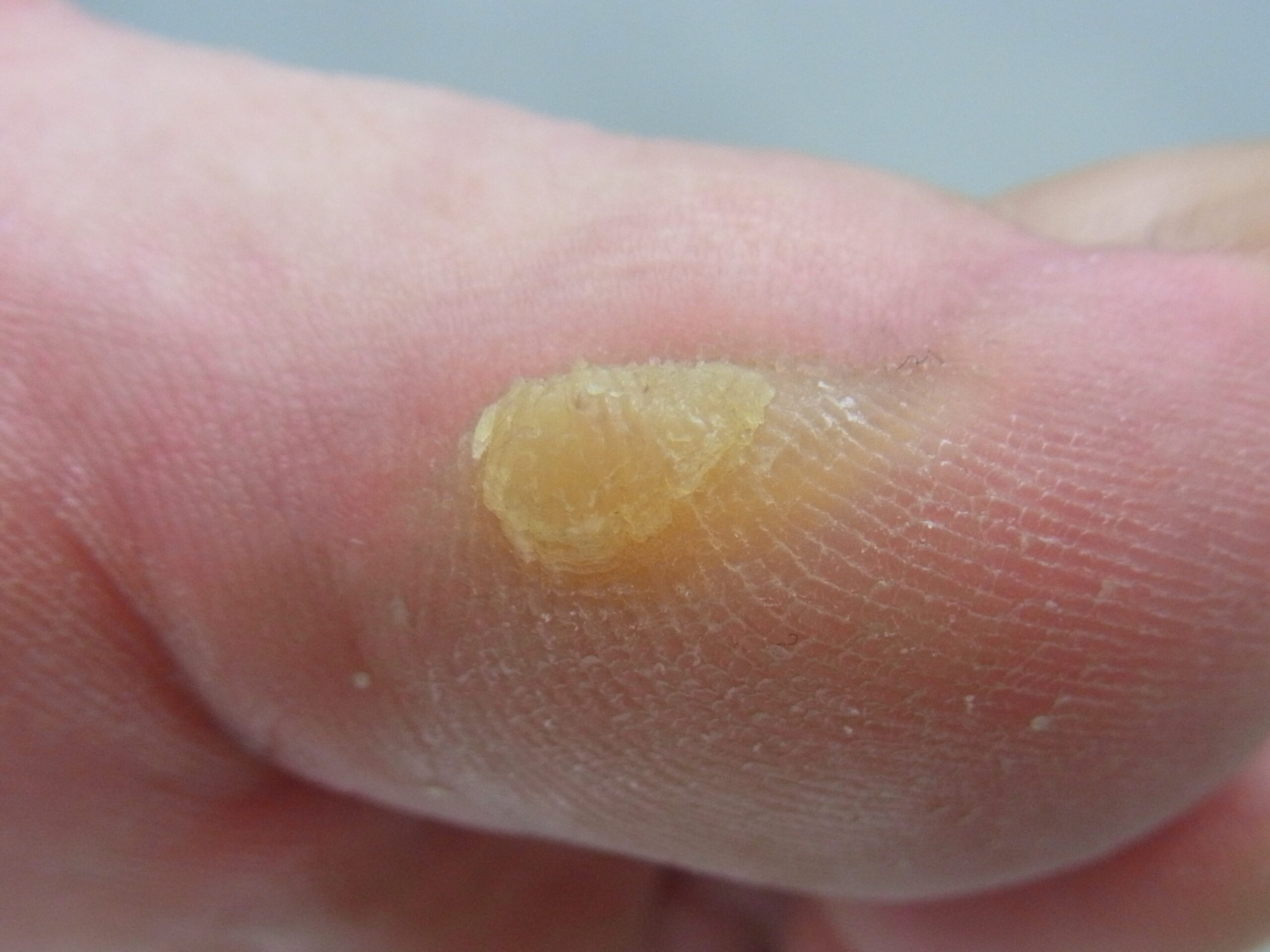 海老名市　巻き爪　ビフォー