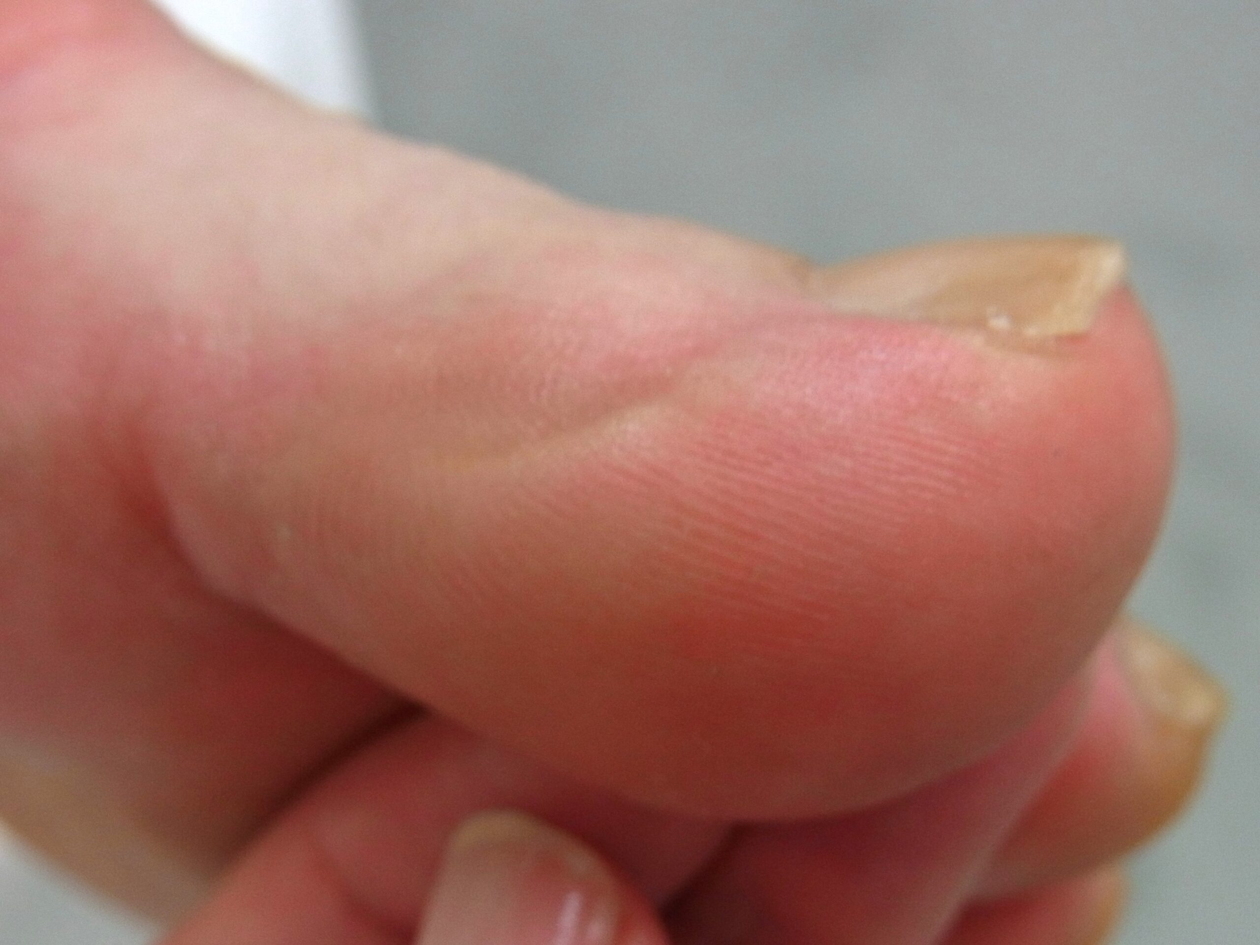 海老名市　巻き爪　アフター