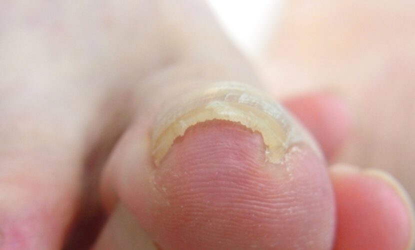 海老名市　巻き爪　ビフォー