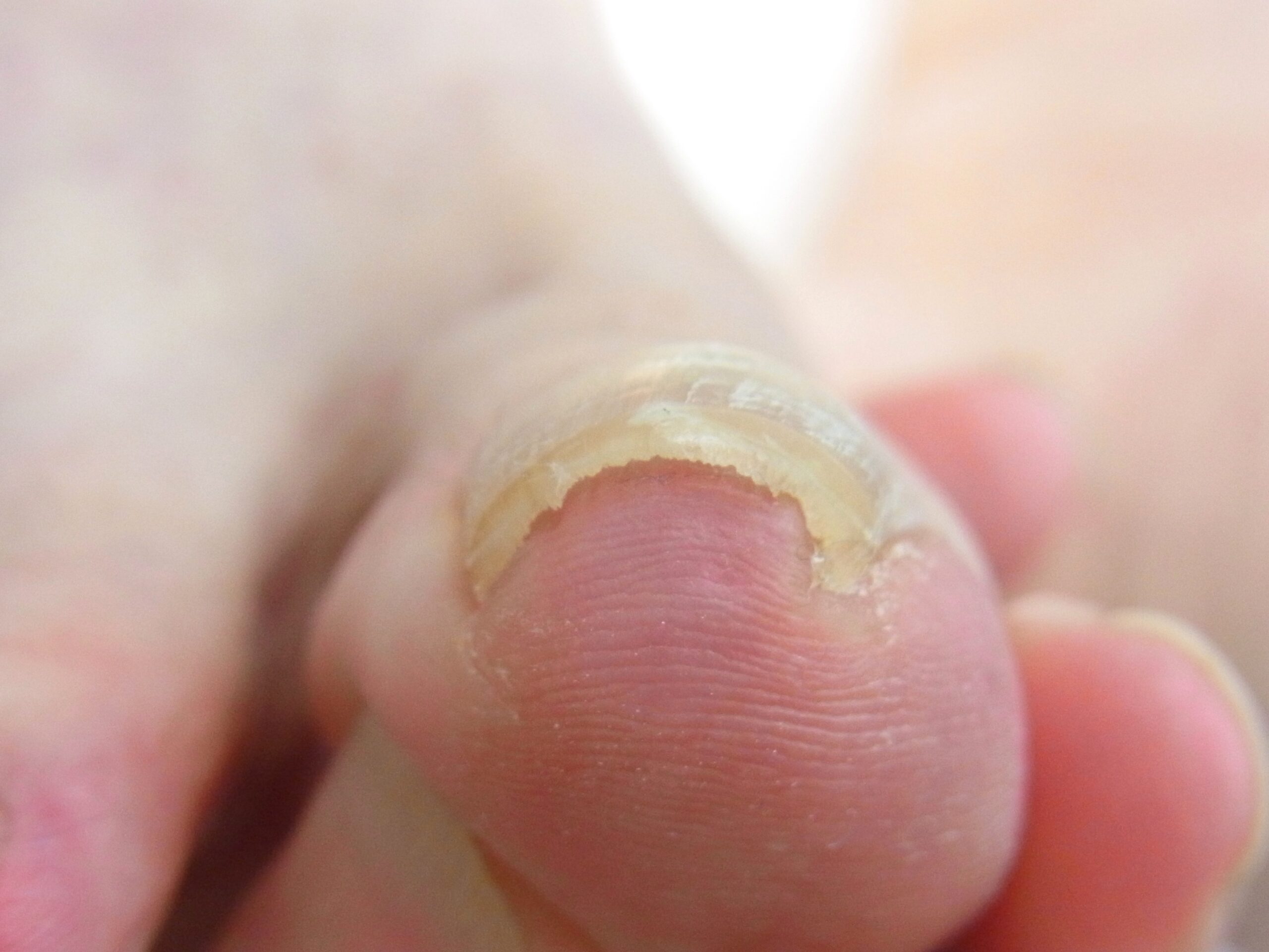 海老名市　巻き爪　ビフォー