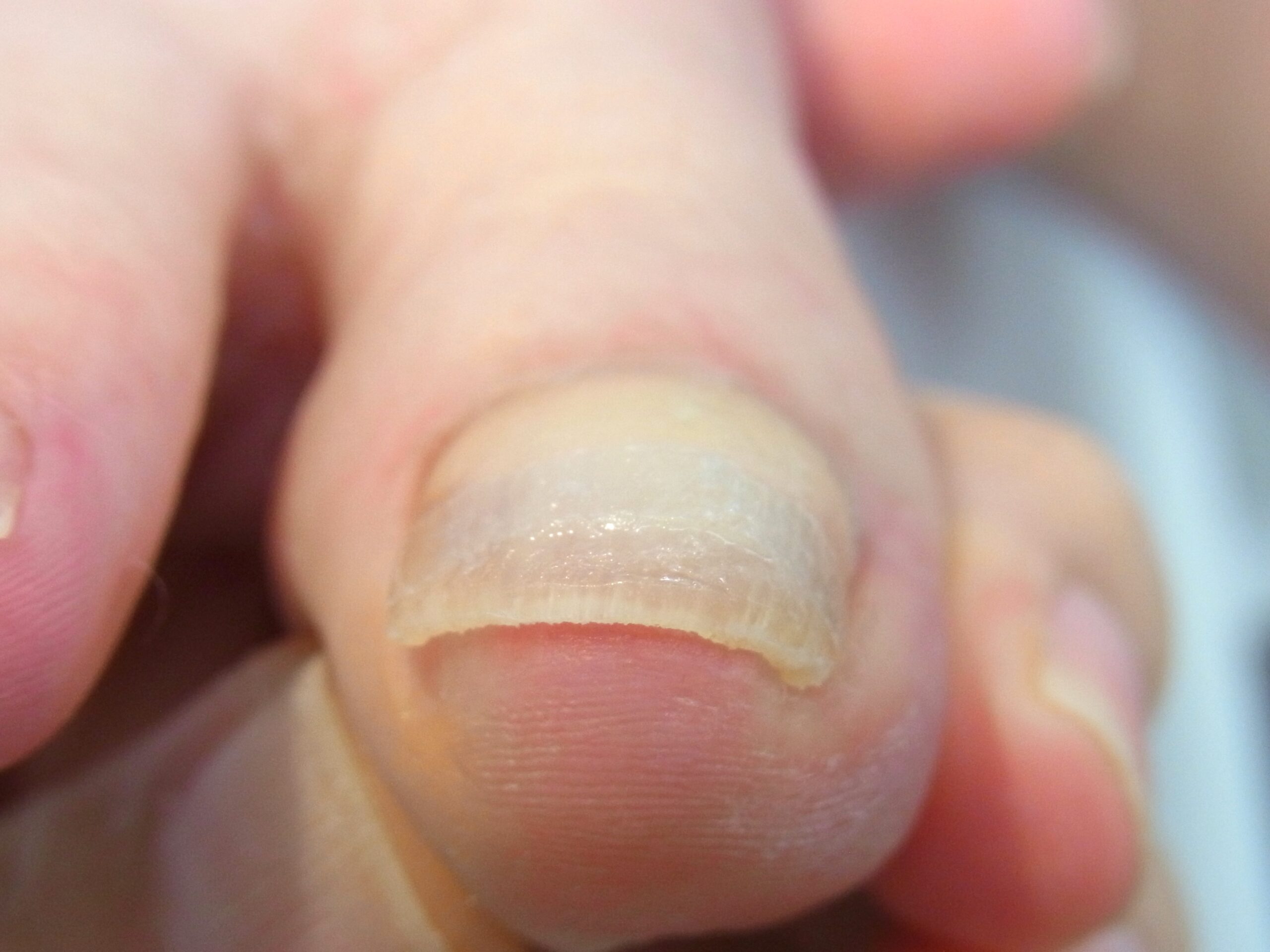 海老名市　巻き爪　アフター