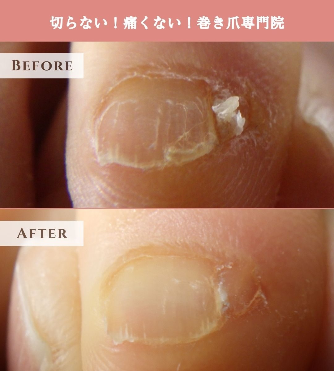 海老名市 巻き爪 副爪