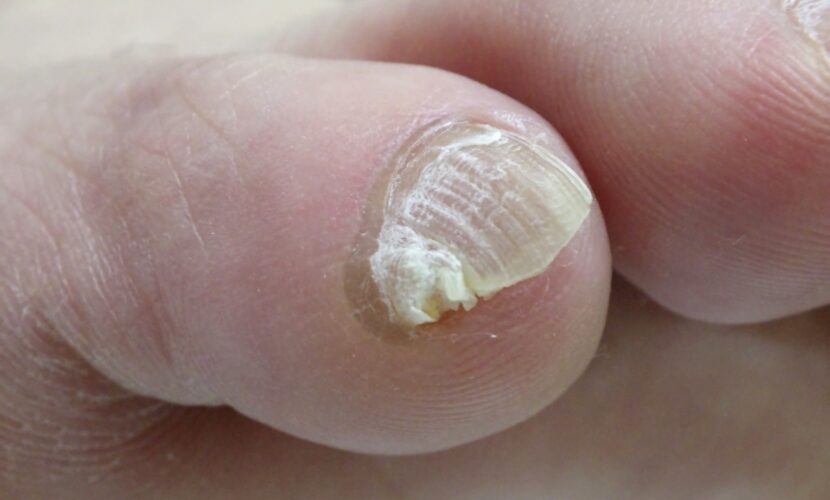 海老名市　巻き爪　副爪