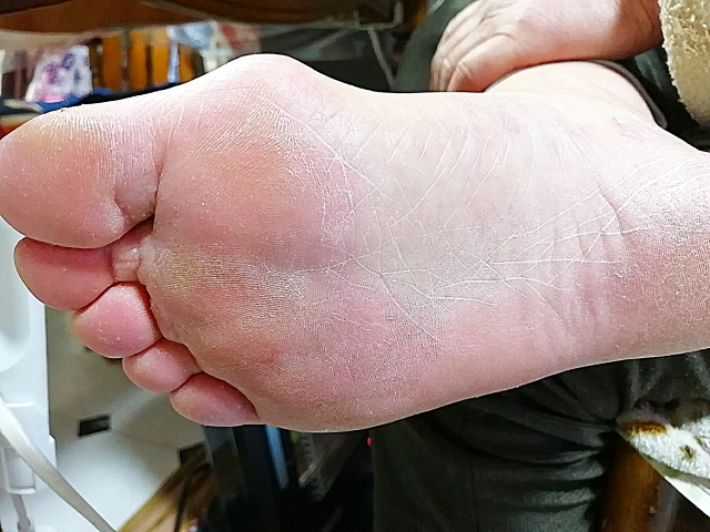 海老名市　巻き爪　足