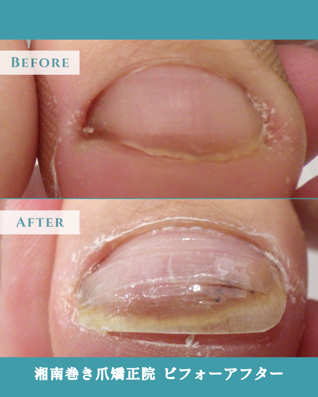 海老名市 巻き爪 陥入爪