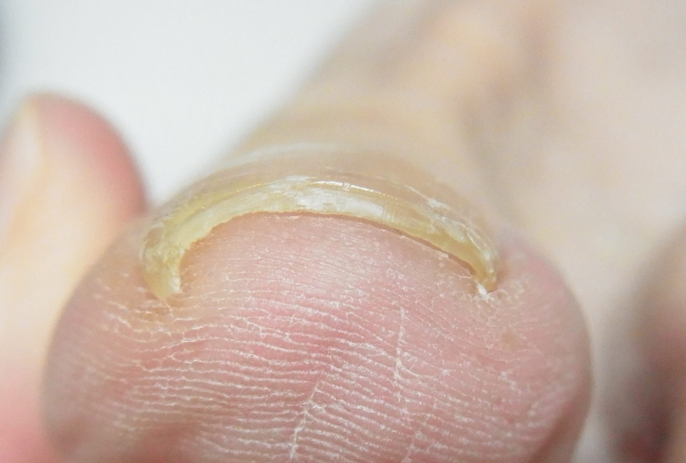 藤沢市　巻き爪　ビフォー