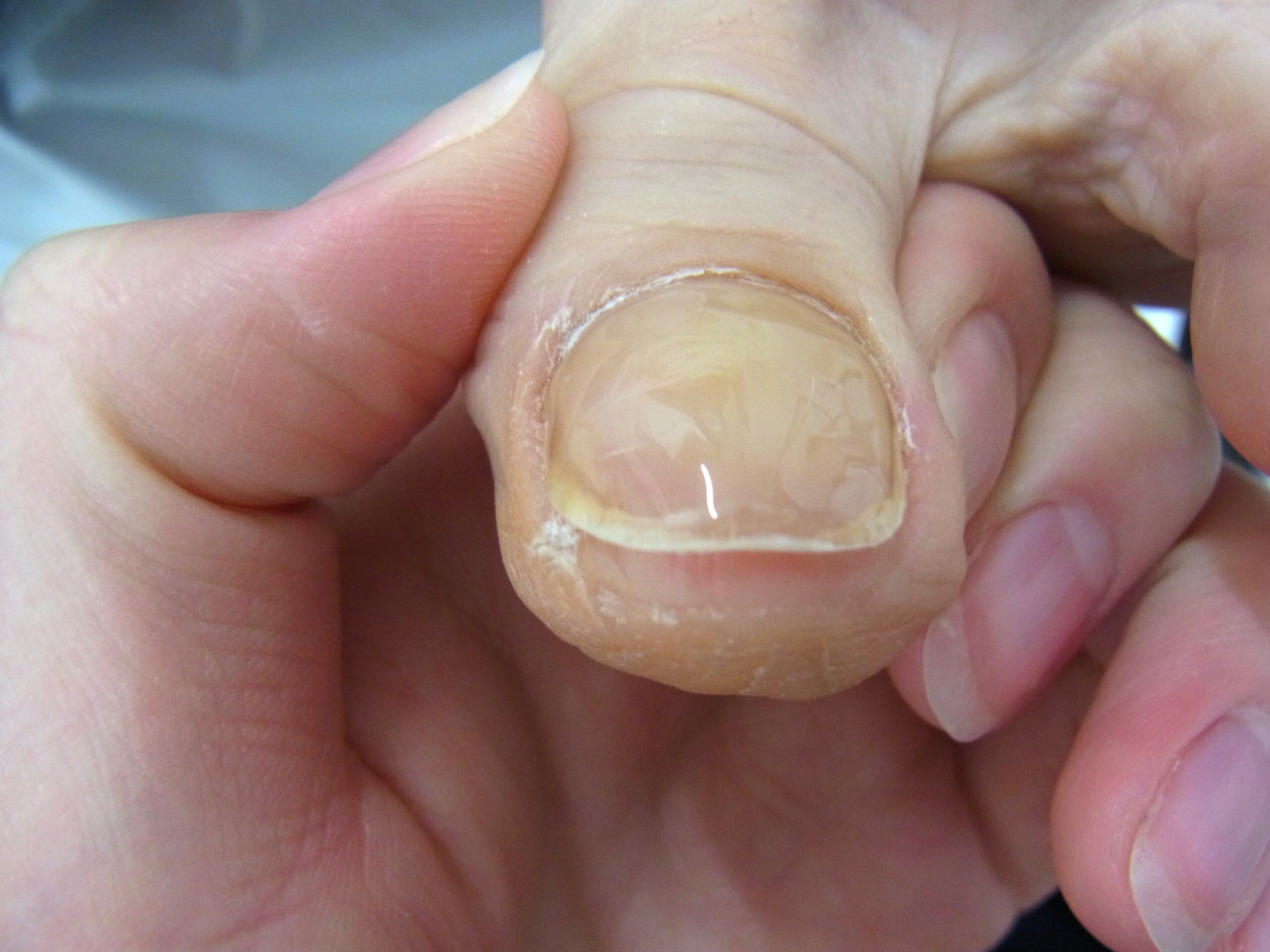 藤沢市　巻き爪　アフター