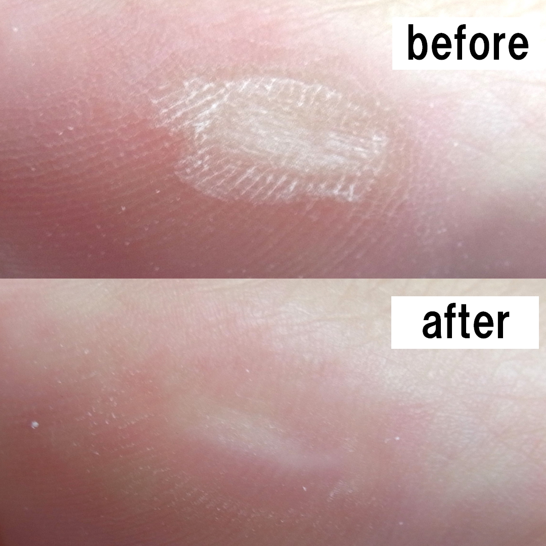 藤沢市　巻き爪　ビフォーアフター