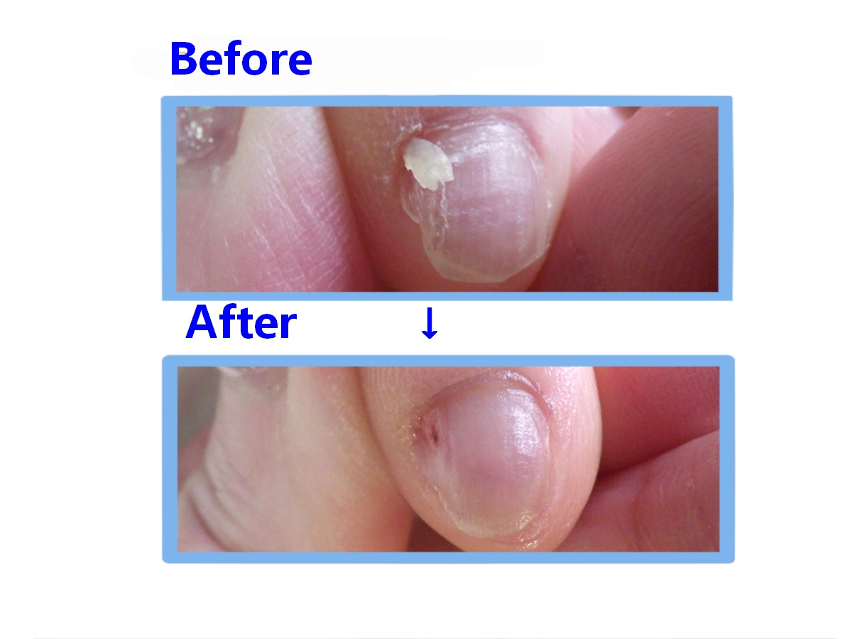藤沢市　巻き爪　副爪