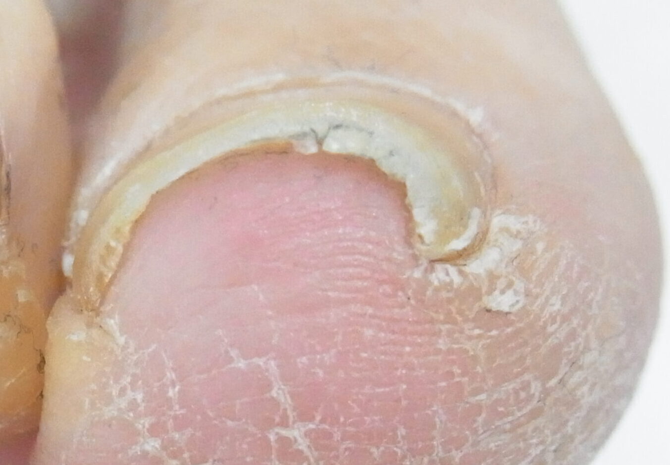 藤沢市　巻き爪　ビフォー