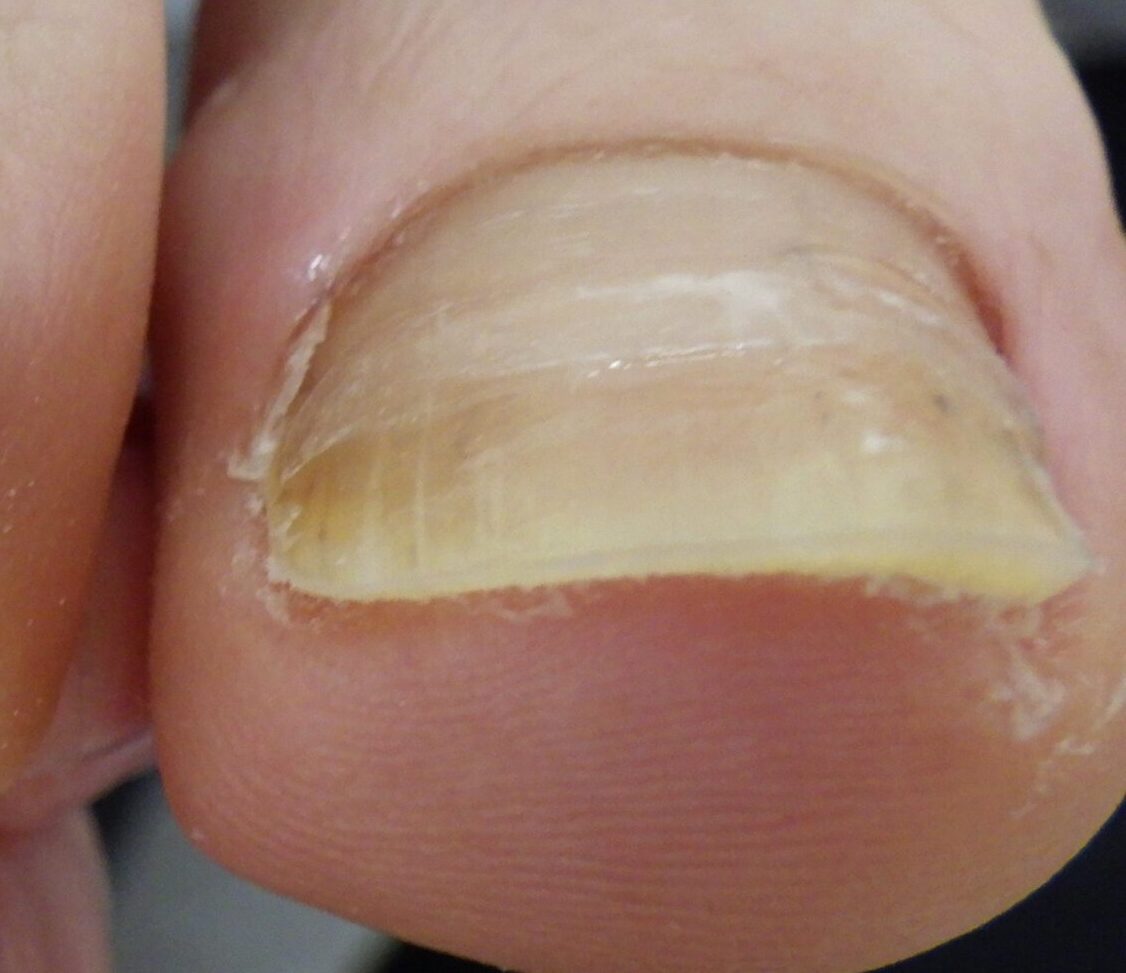 藤沢市　巻き爪　アフター