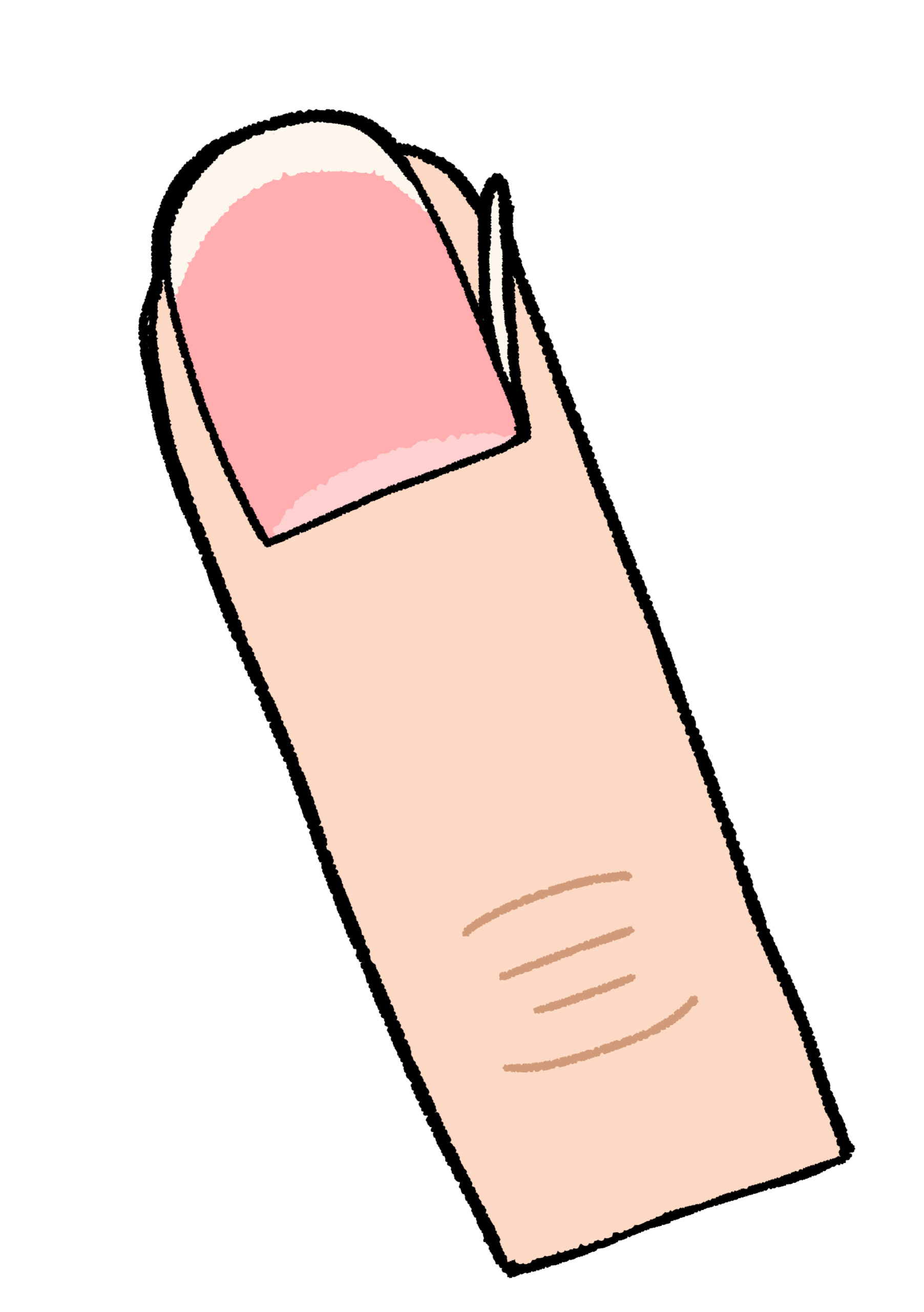 藤沢市　巻き爪　小爪