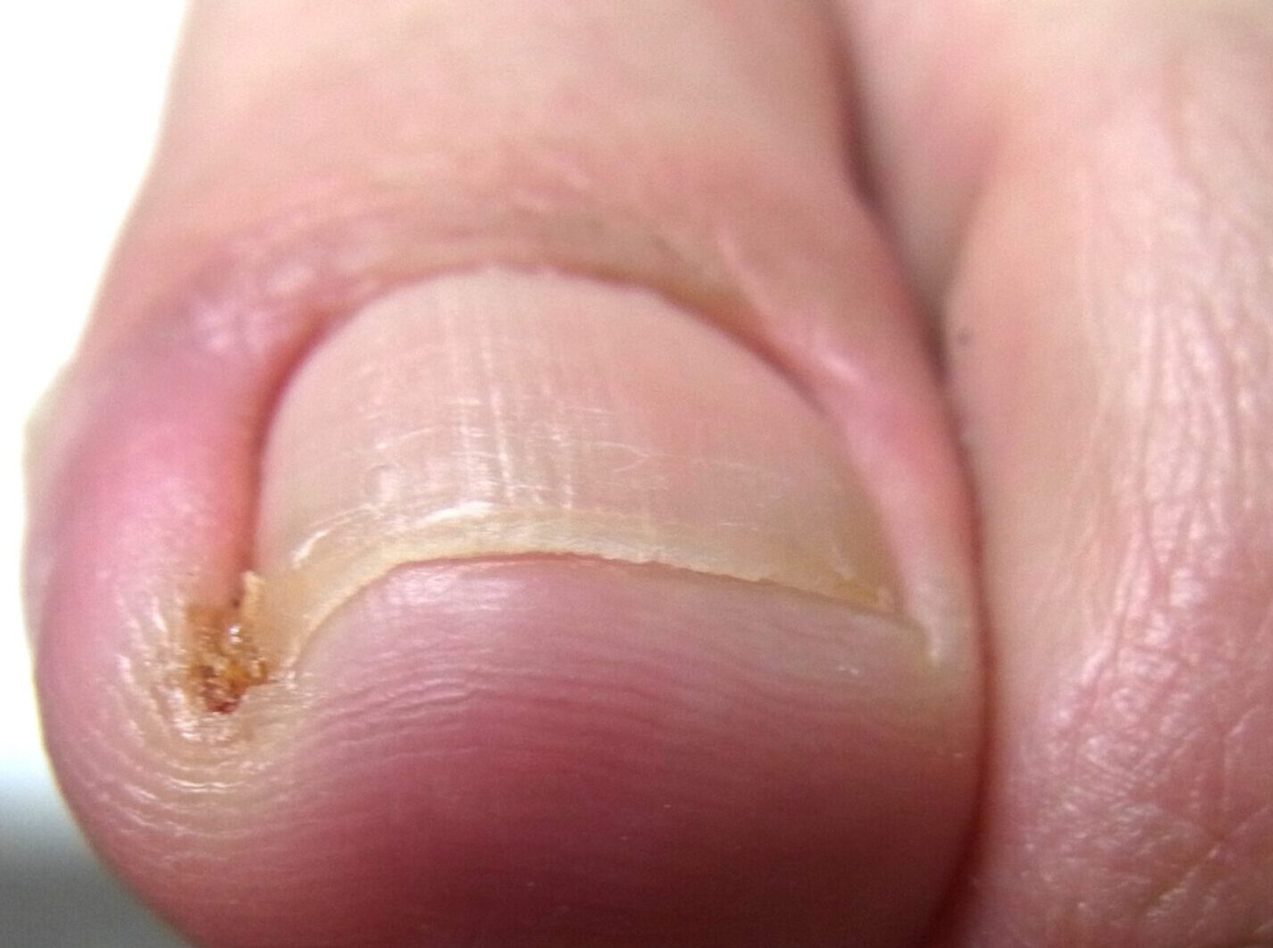 藤沢市　巻き爪　ビフォー