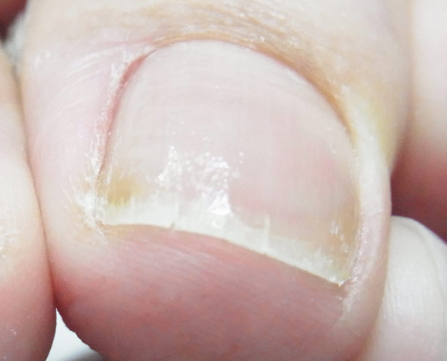 藤沢市　巻き爪　アフター