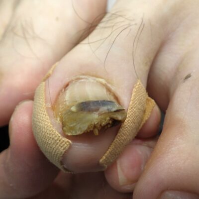 相模原市橋本 巻き爪 ビフォー