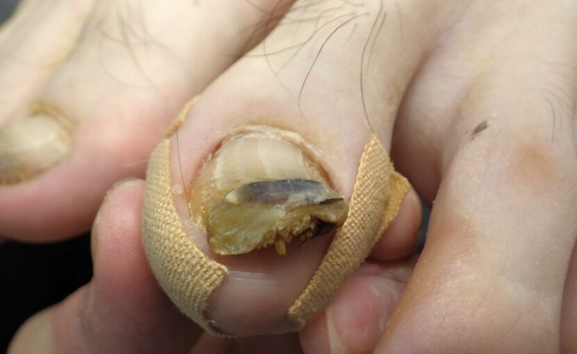 相模原市橋本　巻き爪　ビフォー