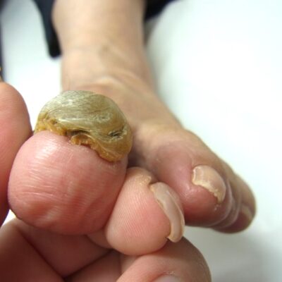 相模原市橋本　巻き爪　ビフォー