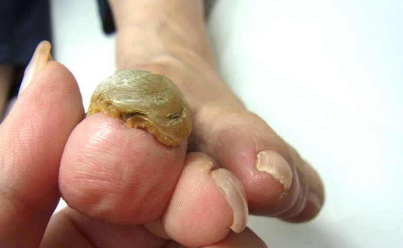 相模原市橋本　巻き爪　ビフォー