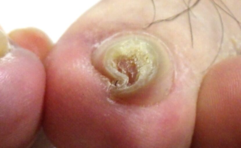 相模原市橋本　巻き爪　ビフォーアフター