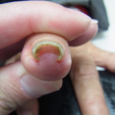 相模原市橋本　巻き爪　ビフォー