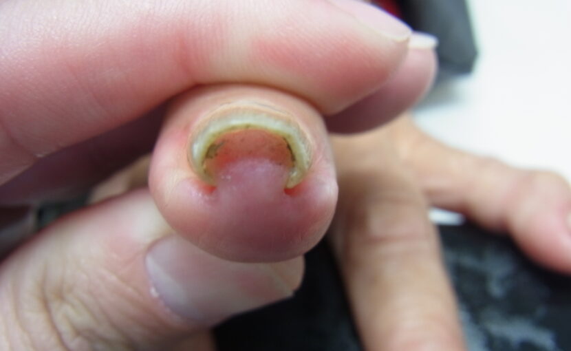 相模原市橋本　巻き爪　ビフォー