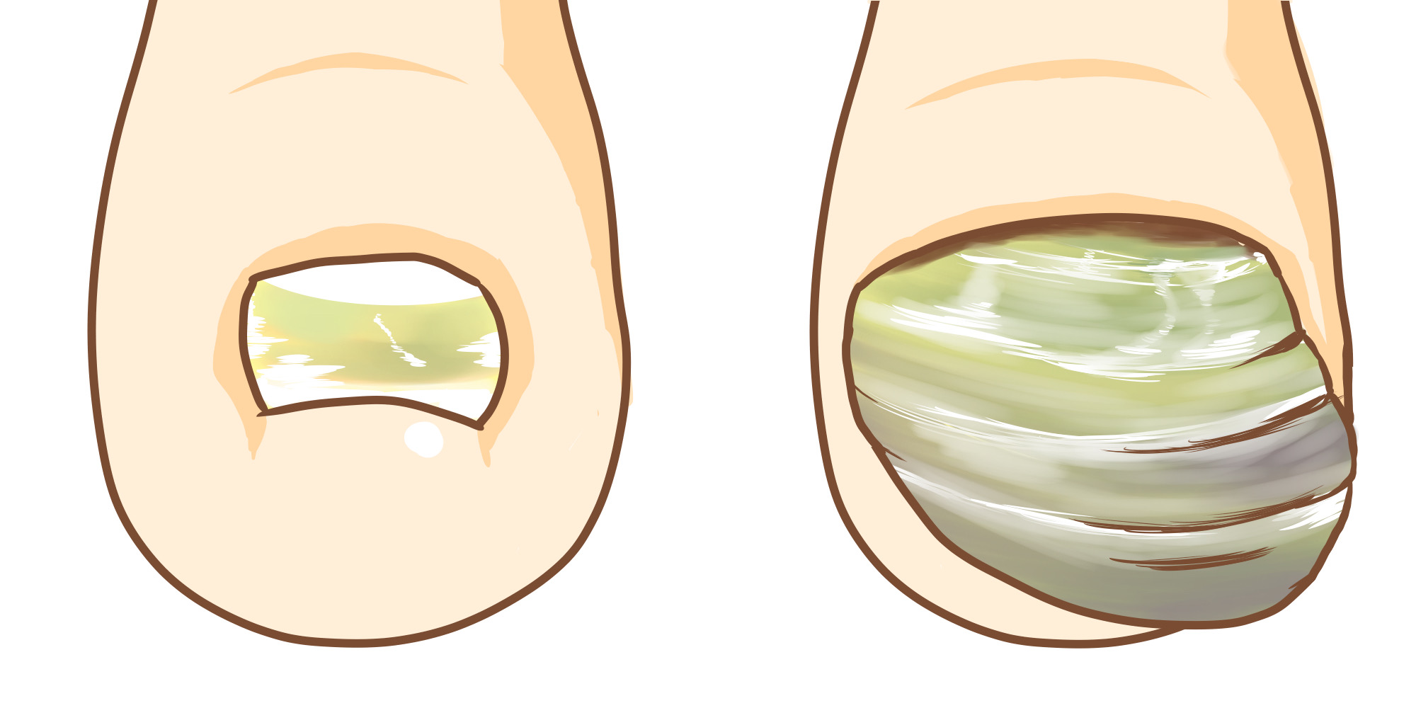 爪 に 横 の 線