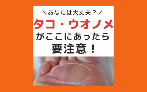 平塚市　巻き爪　タコ　魚の目
