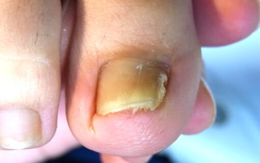 平塚市　巻き爪　ビフォー