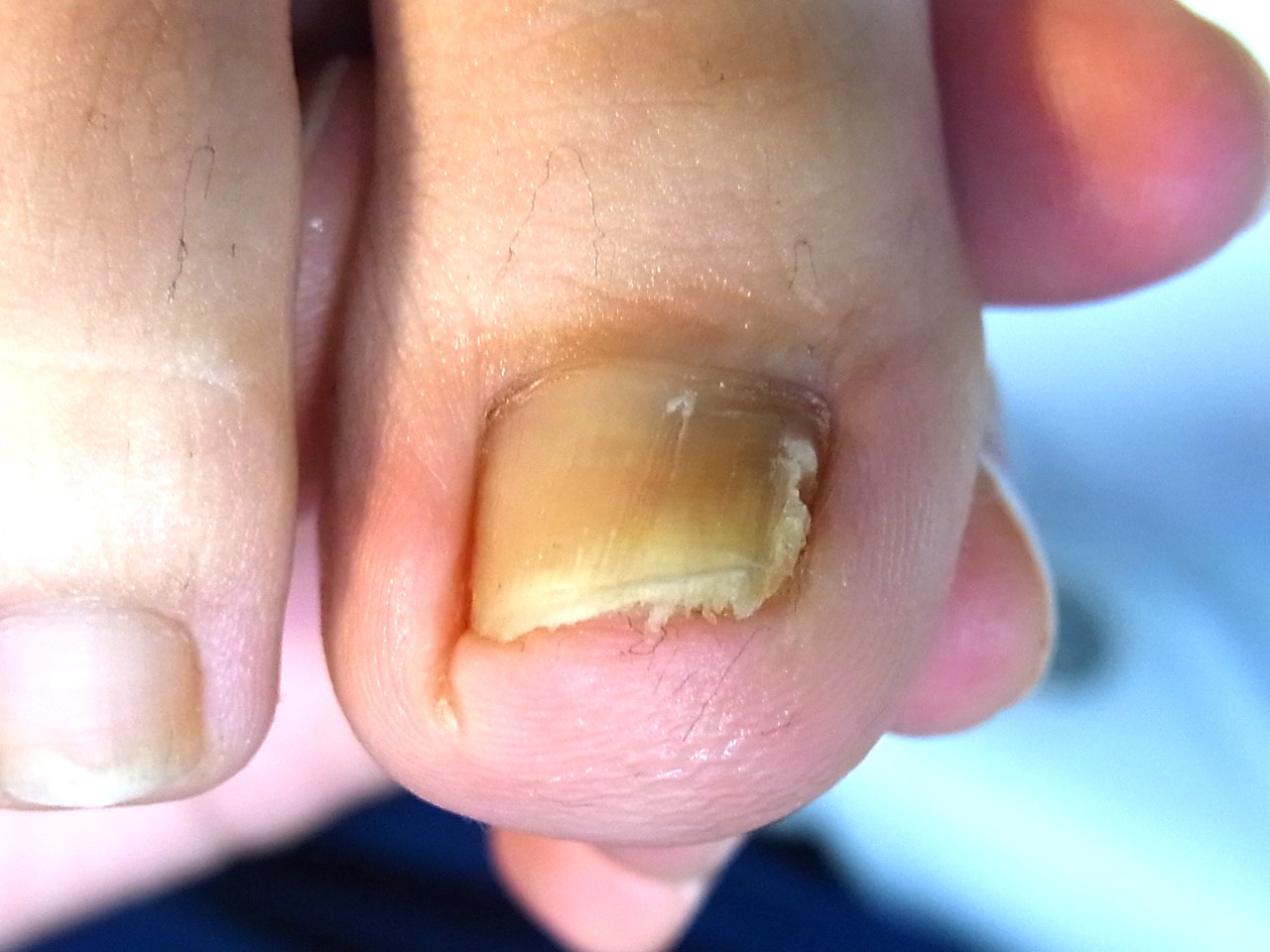 平塚市　巻き爪　ビフォー