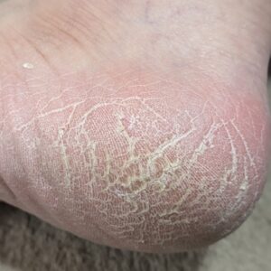 平塚市　巻き爪　足