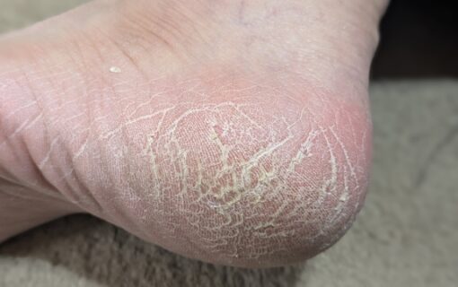 平塚市　巻き爪　足