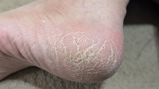 平塚市 巻き爪 足