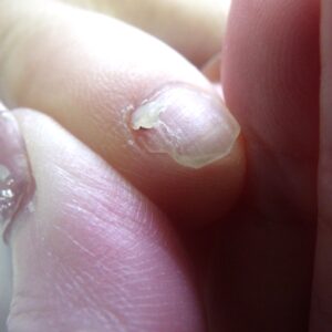 平塚市　巻き爪　副爪