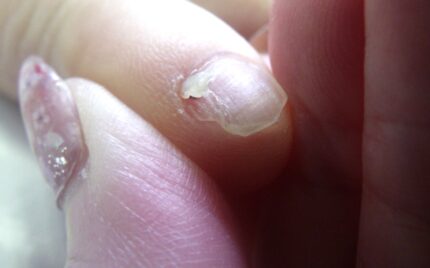 平塚市　巻き爪　副爪