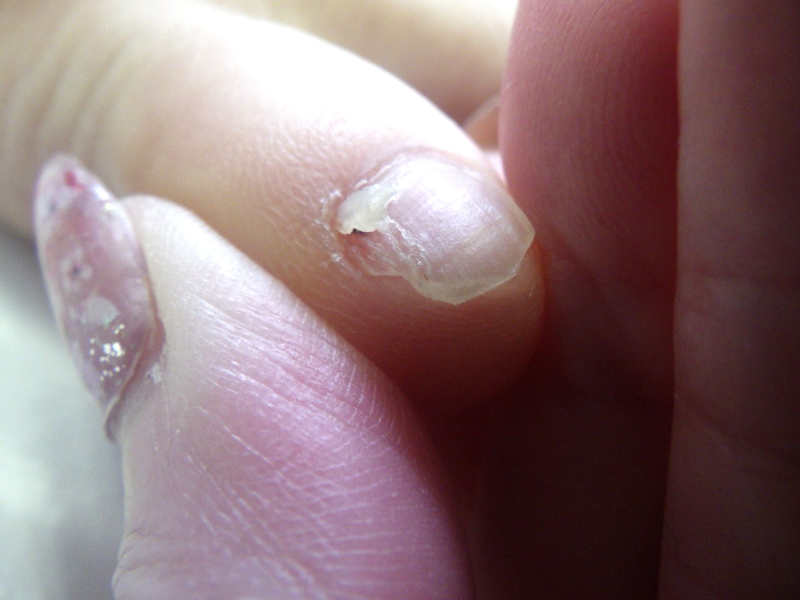 平塚市　巻き爪　副爪