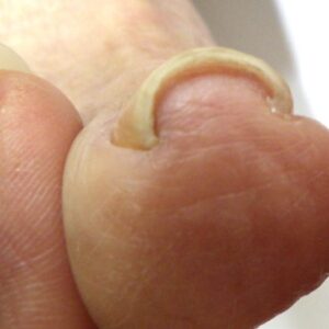 平塚市　巻き爪　ビフォー