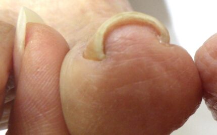 平塚市　巻き爪　ビフォー