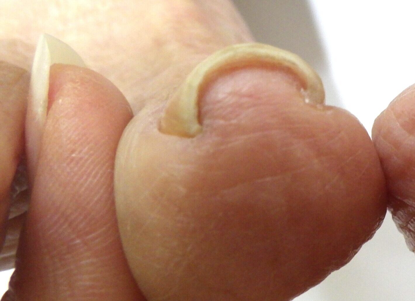 平塚市　巻き爪　ビフォー